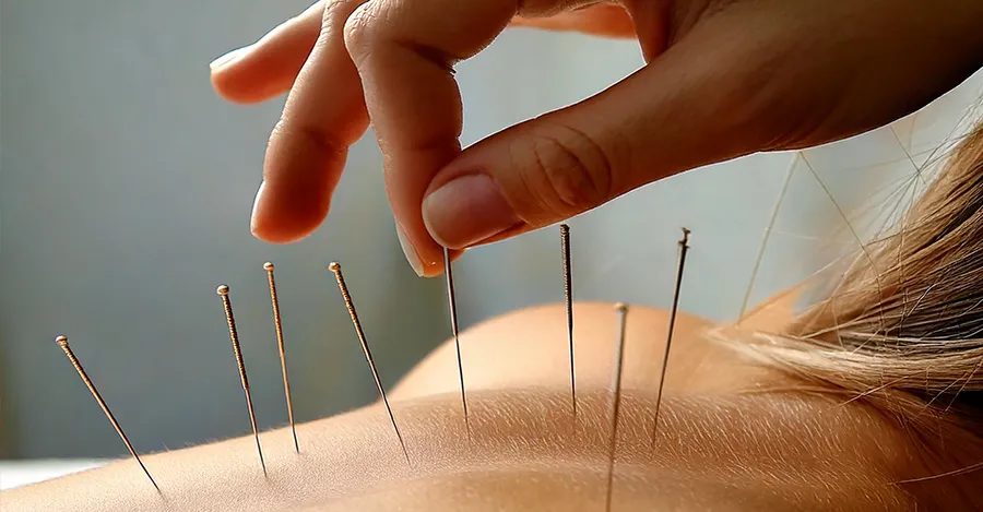 New Acupuncture Offered at Everybody Matters Massage in Brampton